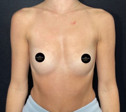 Breast Augmentation Before & After Patient #712