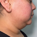 Chin Lipo Before & After Patient #779