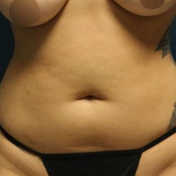Liposuction Before & After Patient #792