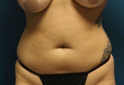 Liposuction Before & After Patient #792
