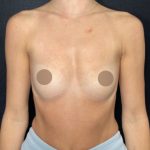 Breast Augmentation Before & After Patient #712