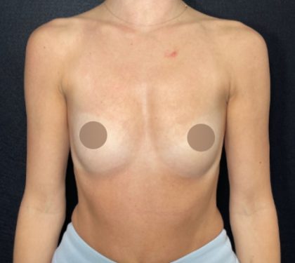 Breast Augmentation Before & After Patient #712