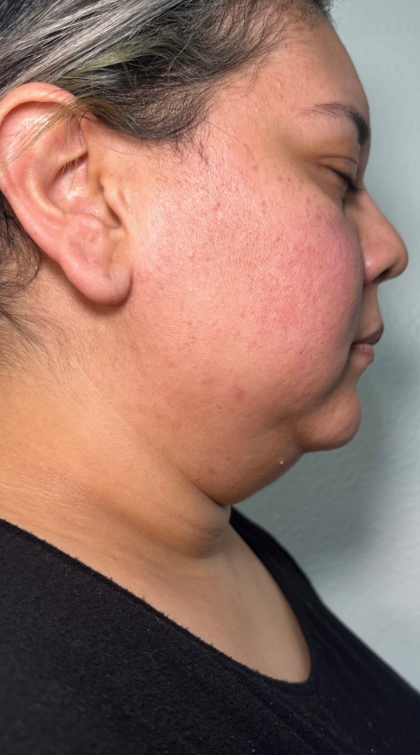 Chin Lipo Before & After Patient #779