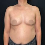 Breast Augmentation Before & After Patient #653