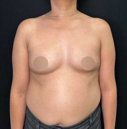 Breast Augmentation Before & After Patient #653