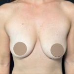 Breast Augmentation Before & After Patient #650