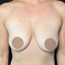 Breast Augmentation Before & After Patient #650