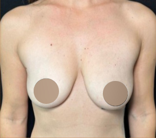 Breast Augmentation Before & After Patient #650