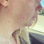 Chin Lipo Before & After Patient #785