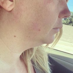 Chin Lipo Before & After Patient #785