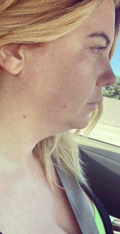 Chin Lipo Before & After Patient #785