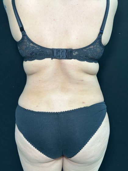 Liposuction Before & After Patient #761