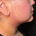 Chin Lipo Before & After Patient #779