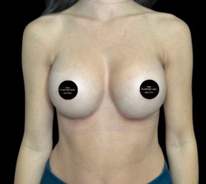 Breast Augmentation Before & After Patient #712