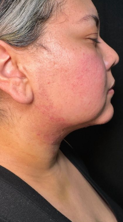 Chin Lipo Before & After Patient #779
