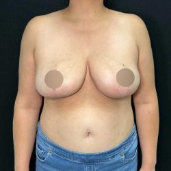 Breast Reduction Before & After Patient #721