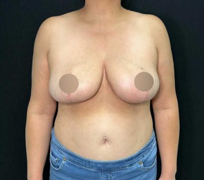 Breast Reduction Before & After Patient #721