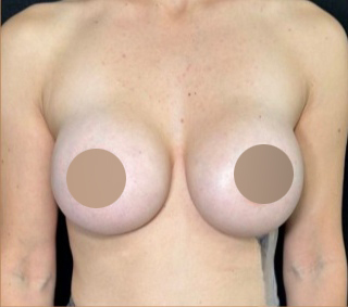 Breast Augmentation Before & After Patient #650