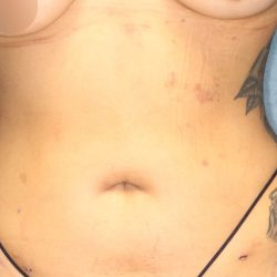 Liposuction Before & After Patient #792