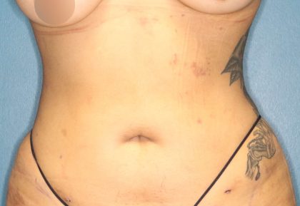 Liposuction Before & After Patient #792