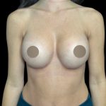 Breast Augmentation Before & After Patient #712