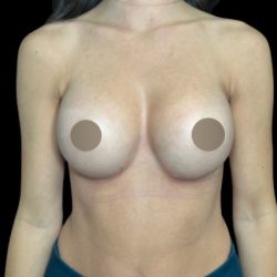 Breast Augmentation Before & After Patient #712