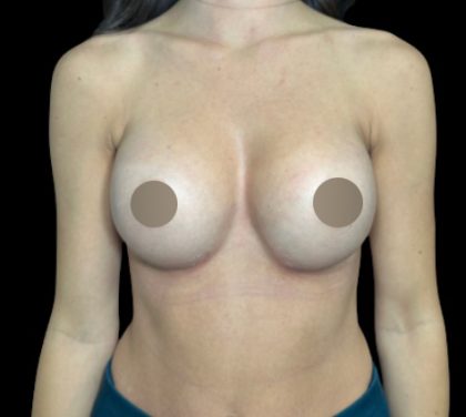 Breast Augmentation Before & After Patient #712