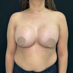 Breast Augmentation Before & After Patient #653
