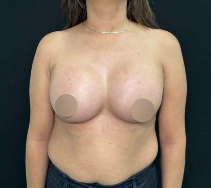 Breast Augmentation Before & After Patient #653