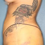 Liposuction Before & After Patient #792