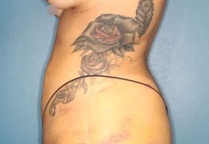 Liposuction Before & After Patient #792