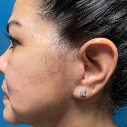 Facelift Before & After Patient #638