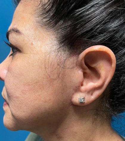 Facelift Before & After Patient #638