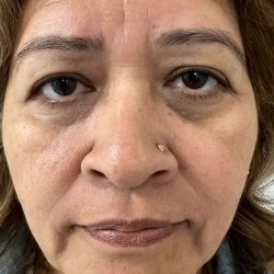 Eyelid Lift Before & After Patient #614