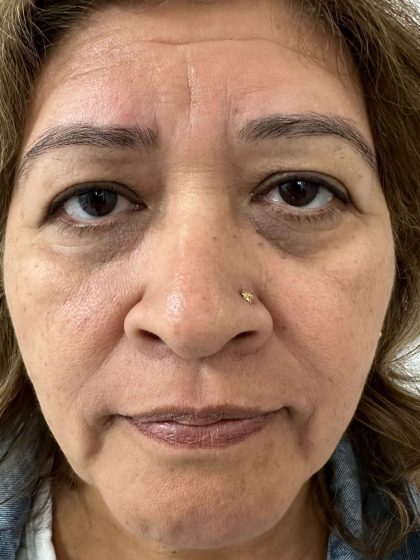 Eyelid Lift Before & After Patient #614