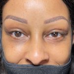 Eyelid Lift Before & After Patient #617