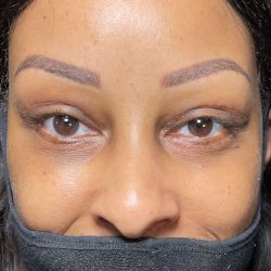 Eyelid Lift Before & After Patient #617