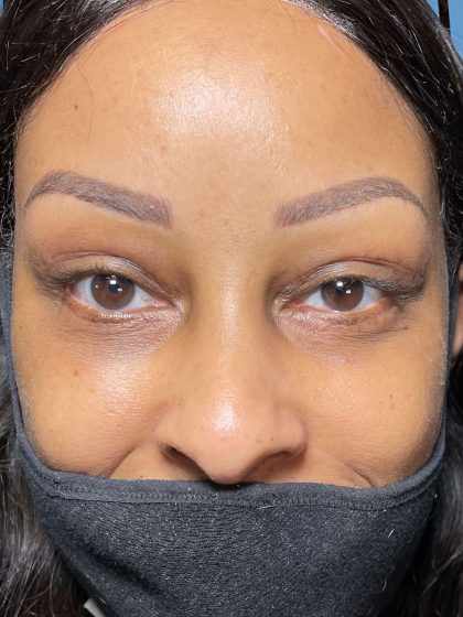 Eyelid Lift Before & After Patient #617