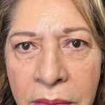 Eyelid Lift Before & After Patient #623