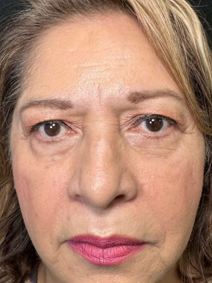 Eyelid Lift Before & After Patient #623