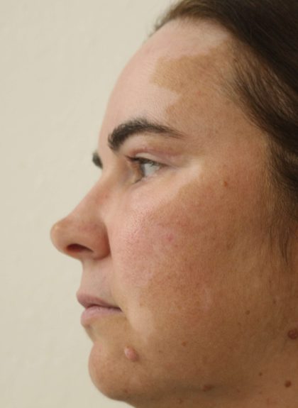 Eyelid Lift Before & After Patient #632