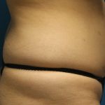 Liposuction Before & After Patient #792