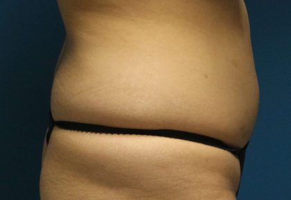 Liposuction Before & After Patient #792