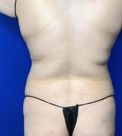 Liposuction Before & After Patient #809