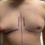 Liposuction Before & After Patient #841