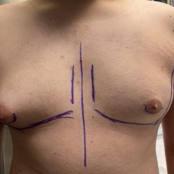 Liposuction Before & After Patient #841