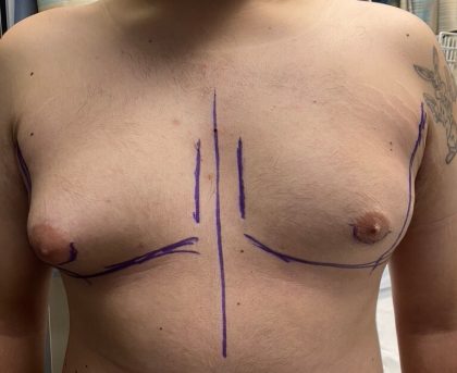 Liposuction Before & After Patient #841