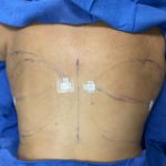 Liposuction Before & After Patient #844