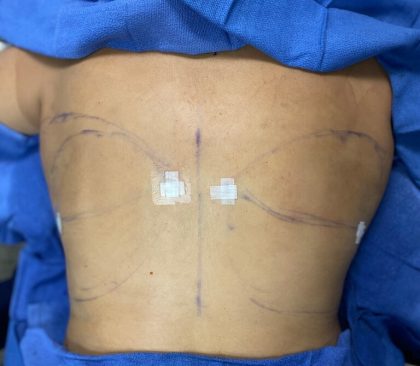 Liposuction Before & After Patient #844