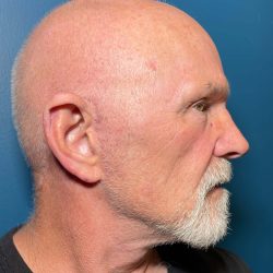 Facelift Before & After Patient #635